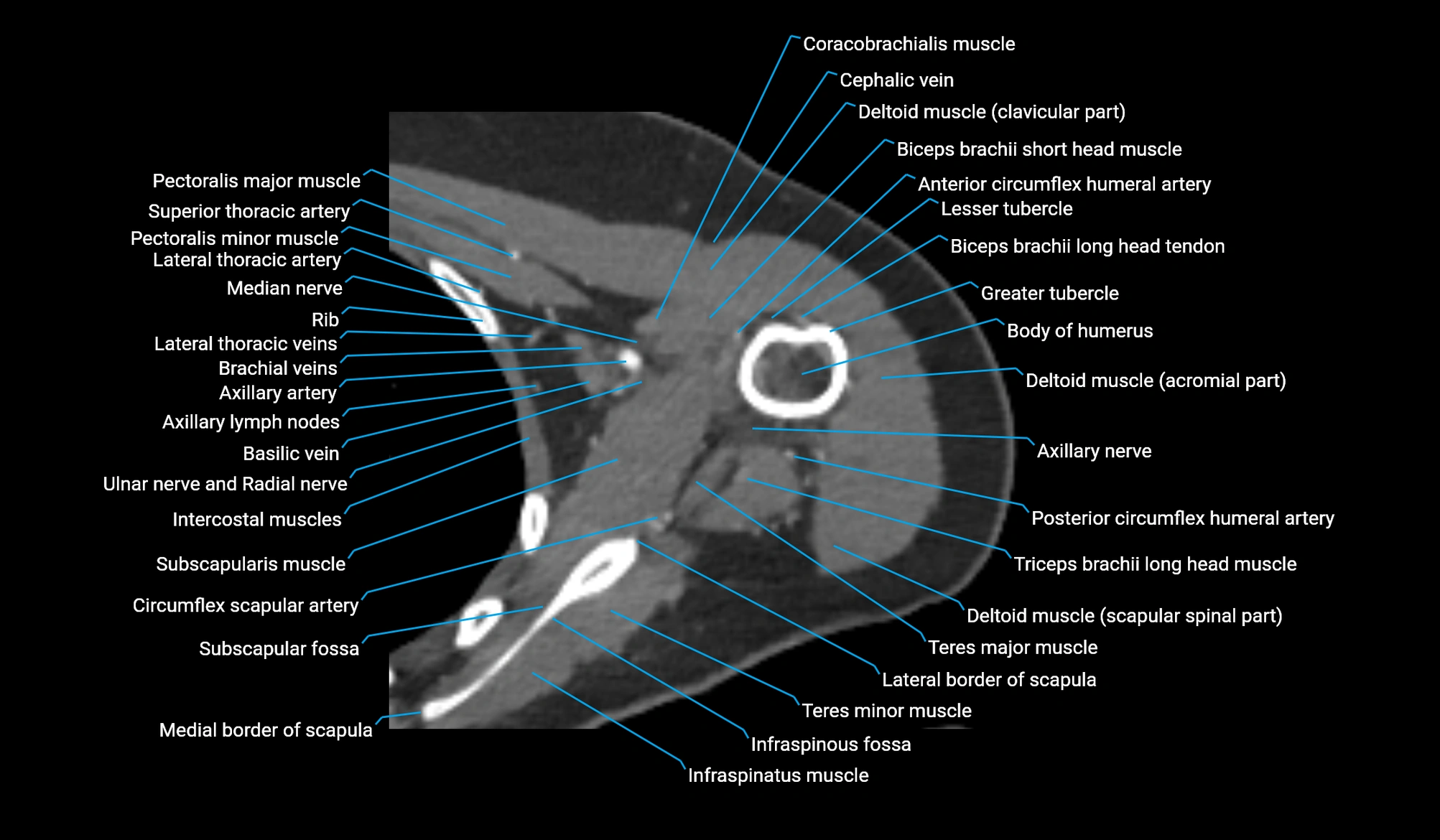 CT upper arm axial  cross sectional anatomy labelled radiology image -00124.webp